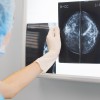 Mammogram image