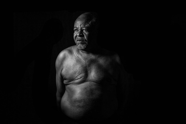 Jose Ferreira, male breast cancer