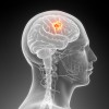 Brain cancer