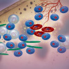 multiple myeloma