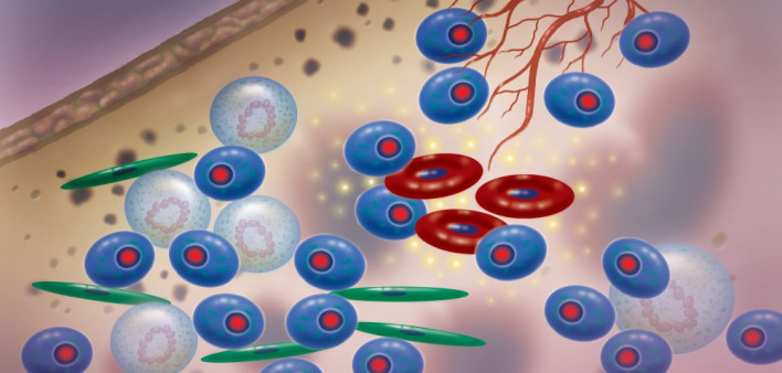 multiple myeloma