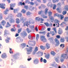Human cells with acute myelocytic leukemia (AML) in the pericardial fluid, shown with an esterase stain at 400x