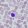 A peripheral blood smear showing several hairy leukemia cells