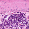 Very high magnification micrograph of Merkel cell carcinoma (MCC). H&E stain.  MCCs are aggressive neuroendocrine tumour of the skin. They can be considered a small round cell tumor.