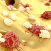 Lymphocytes attacking cancer cells