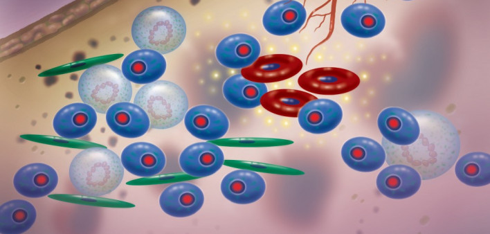 multiple myeloma