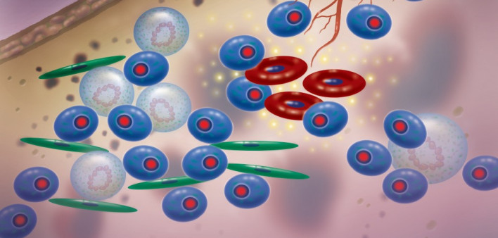 multiple myeloma