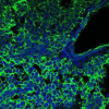 An immunohistochemistry image of small-cell lung cancer, with the tumor cells glowing green