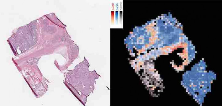 lung cancer, national cancer institute, artificial intelligence, squamous cell carcinoma