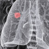 An X-ray of non-small cell lung cancer in a 54-year-old woman