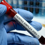 Herpes simplex virus 1 test tube