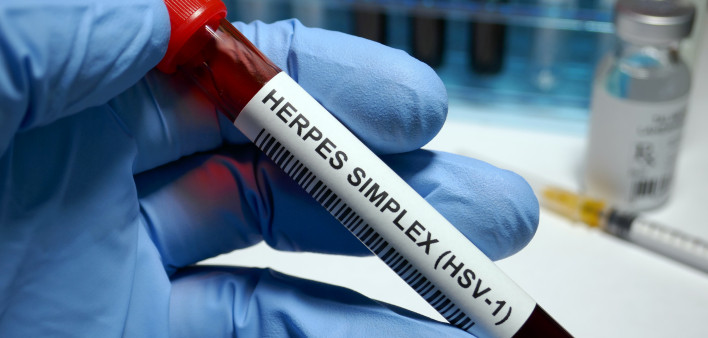 Herpes simplex virus 1 test tube