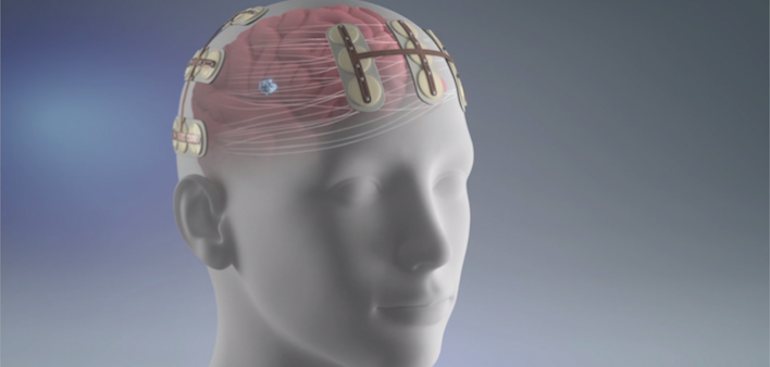 Optune, brain cancer, brain tumor, glioblastoma, treatment