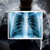 smoke and chest x ray