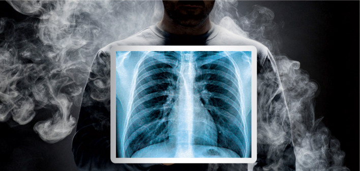 smoke and chest x ray