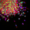 This image shows how lung cancer cells invade surrounding tissues and start to metastasize. These lung cancer cells have a mutation of a gene called LKB1 (in green) that promotes invasion.