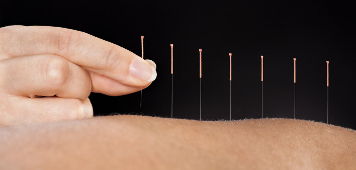 fingers with acupuncture needles in arm
