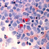 Human cells with acute myelocytic leukemia (AML) in the pericardial fluid, shown with an esterase stain at 400x