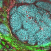 A breast cancer tumor and its microenvironment is shown in a live mouse model. A UCSF team used big data to show how tumors interact with their surroundings