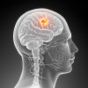 Brain cancer