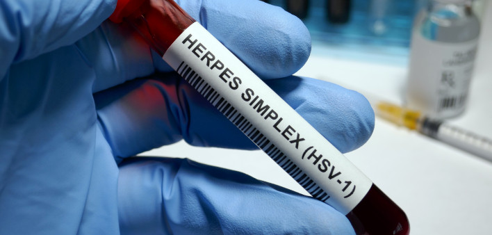 Herpes simplex virus 1 test tube