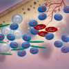 multiple myeloma