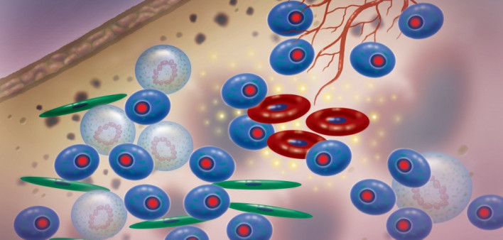 multiple myeloma
