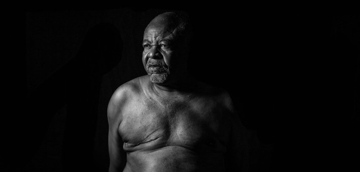 Jose Ferreira, male breast cancer
