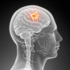 Brain cancer