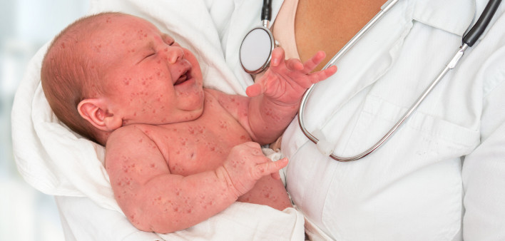 Doctor holding a newborn baby which is sick rubella or measles