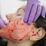 woman gets Revolutionary treatment of rejuvenation with blood plasma vampire facial