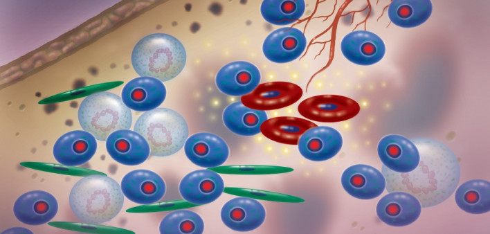 multiple myeloma