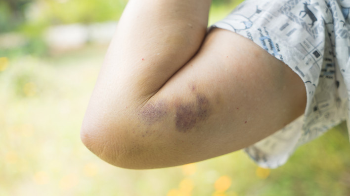 Bruise on womans arm