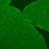 A biospecimen containing a pattern researchers have dubbed ”sparkling” because of how the sample looks under a microscope. Researchers noticed that the the patients with these samples had the same clinical story: They had ataxia and testicular cancer.