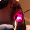 UB scientists use light to treat a painful side effect of cancer