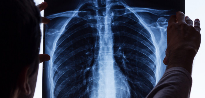 Doctor holdin up chest-xray