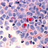 Human cells with acute myelocytic leukemia (AML) in the pericardial fluid, shown with an esterase stain at 400x
