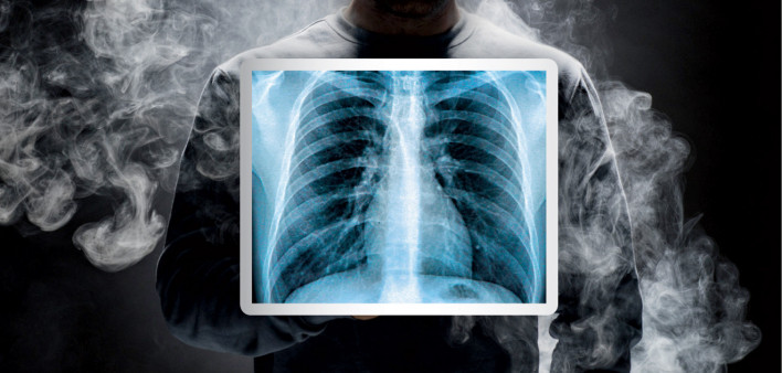 smoke and chest x ray