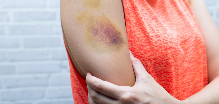 Bruise on womans arm
