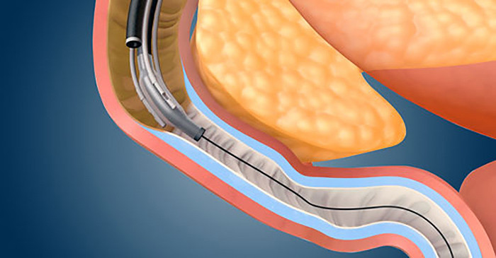duodenal mucosal resurfacing (DMR)