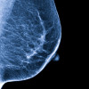 Mammogram image