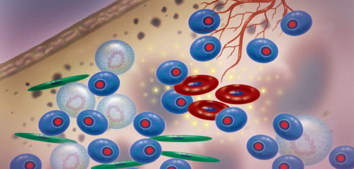 multiple myeloma