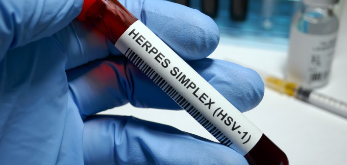 Herpes simplex virus 1 test tube