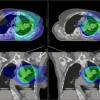 Traditional radiation therapy (top and bottom left) delivers radiation to the tumor and to healthy tissues around the tumor. With proton therapy (top and bottom right), the majority of the radiation is delivered to the tumor.