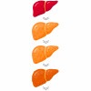 stages of liver disease