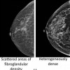 Breasts can be fatty or dense. The left image shows fatty tissue in a breast and the right images show increasing degrees of breast density. Dense tissue, which appears white on mammograms, masks the presence of breast tumors, which also appear white.