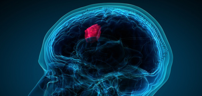 x-ray of brain showing tumor.