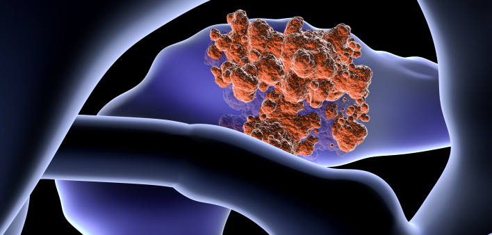 Pancreatic cancer