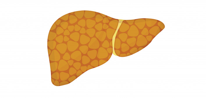 liver steatosis
