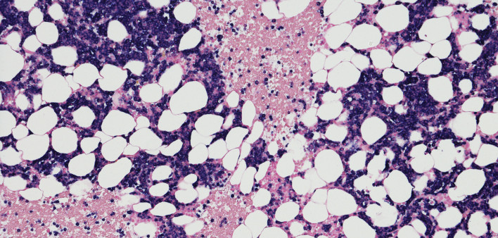 Micrograph of myeloma neoplasm from bone marrow biopsy